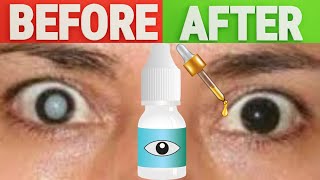 Solution for Cataract: The #1 Ultimate Cure for Cataracts