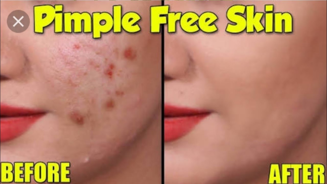 How To Remove Pimples In 5 Days Get Rid Of Pimples Fast In Telugu