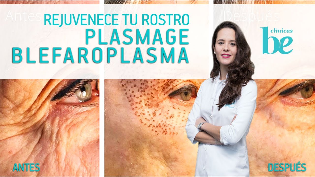 Blefaroplasma, la alternativa a la cirugía de párpados | Clínicas Be | Luce una mirada más joven
