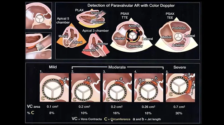 Echocardiographic Assessment of Prosthetic Valves