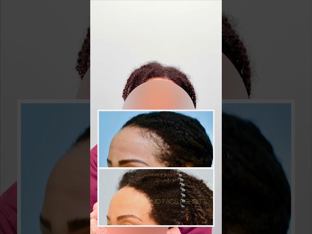 Traction Alopecia Hair Transplant Closeup, Testimonial and Photos