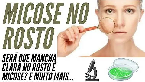 O que é bom para tirar manchas de micose?
