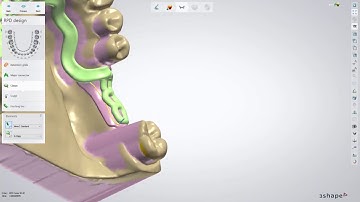 232 - Lower RPD Class II mod 1