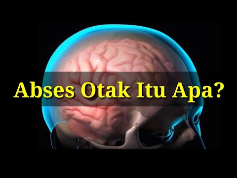 Video: Abses Otak: Faktor Risiko, Gejala & Diagnosis