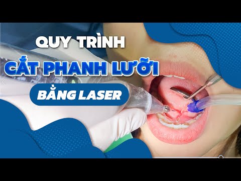 Video Phẫu Thuật Cắt Thắng Lưỡi (Phanh Lưỡi) Bám Thấp Ở... - youtube