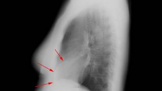 Left ventricular aneurysm