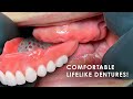 How to Create Comfortable Lifelike Dentures
