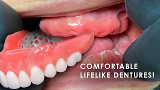 How to Create Comfortable Lifelike Dentures