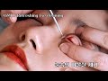 ASMR SUB Special Eye Cleaning Remove Foreign Substances From Eye Bubbles ASMR SUB Special Eye Cleaning Remove Foreign Substances From Eye Bubbles