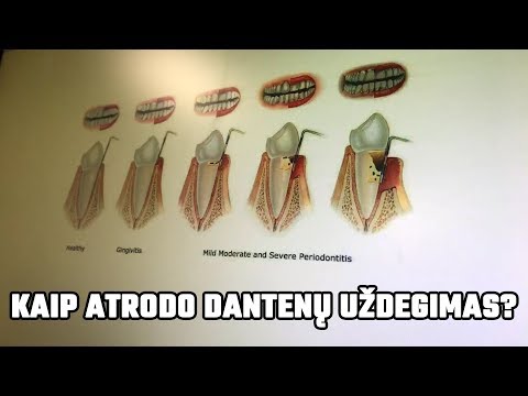 Video: 3 būdai išgydyti dantenų uždegimą