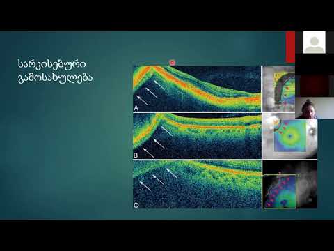 თინათინ ჯიქურაშვილი - ოპტიკურ კოჰერენტული ტომოგრაფია - ინტერპრეტაცია და არტეფაქტები