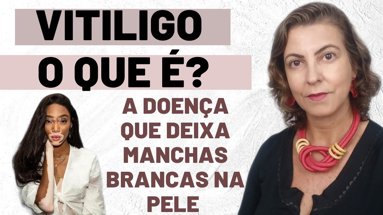(#380) Vitiligo - a doença que deixa manchas brancas na pele - YouTube
