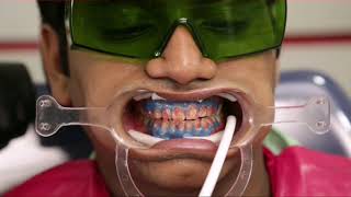Teeth Whitening :Scaling Treatment||Teeth scaling and Root Planing procedure #DeepCleaning