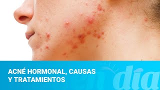 Acné hormonal, causas y tratamientos