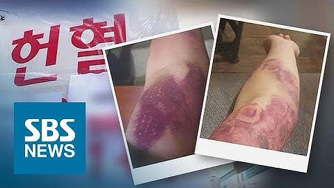 헌혈하다 동맥 파열됐는데…보상 대책 없는 혈액원 / SBS