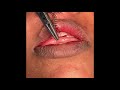 Revision lip repair surgery - Scar revision and muscle repair operation by Dr Richardson