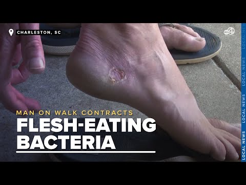 Man contracted a flesh-eating bacteria after walking on Lowcountry beach