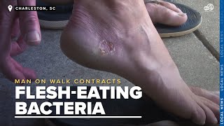 Man Contracted A Flesh-Eating Bacteria After Walking On Lowcountry Beach