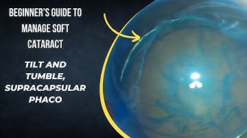 Case series 47. Beginners guide to manage soft cataract, tilt and tumble supracapsular topical phaco