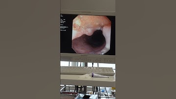 Nuốt nghẹn và ung thư thực quản