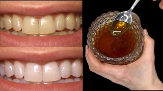 Secret that Dentists don't want you to know: Remove Tartar and Teeth Whitening in just 2 minutes🪥🦷