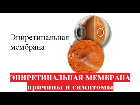 Эпиретинальная мембрана сетчатки