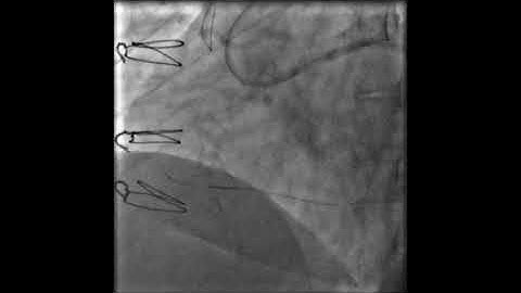 Retrograde CTO PCI through an epicardial channel