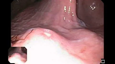 Type II Peptic Ulcer - DayDayNews