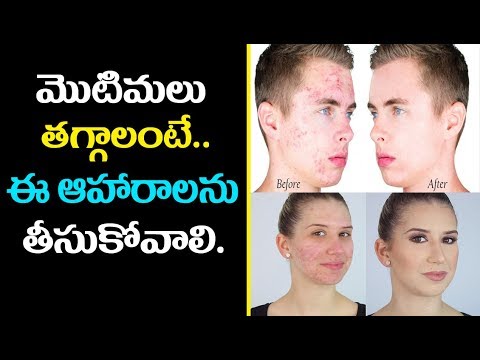 Diet Tips to Get Rid of Acne | Clean Diet | How To Get Rid Of Pimples And Acne Naturally