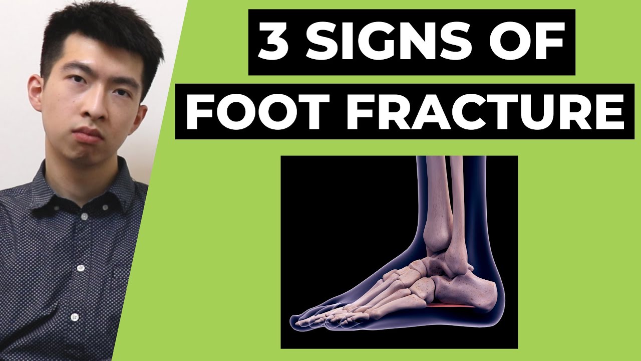 Foot Fracture How to Identify Foot Fracture after Ankle Sprain (Top 3