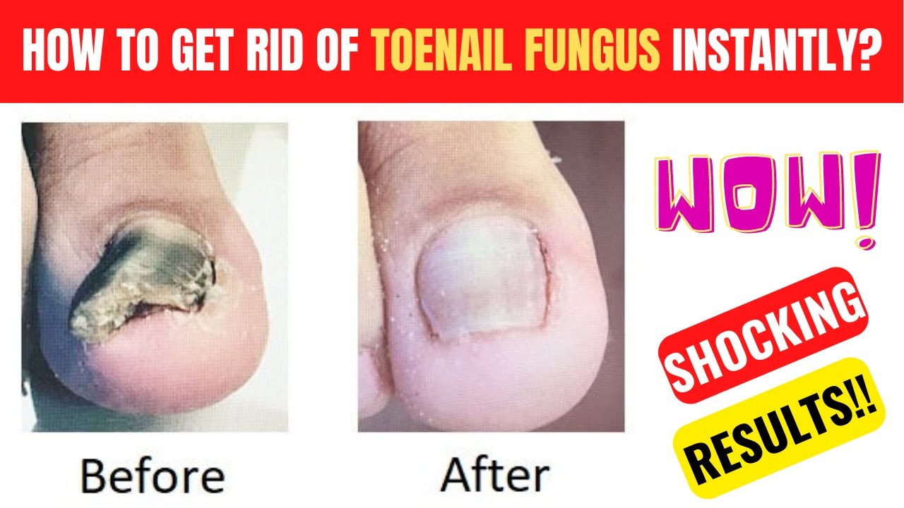 How To Get Rid Of Toenail Fungus Instantly| Fungus Elixir Review| #toenailart  #toenail_removing