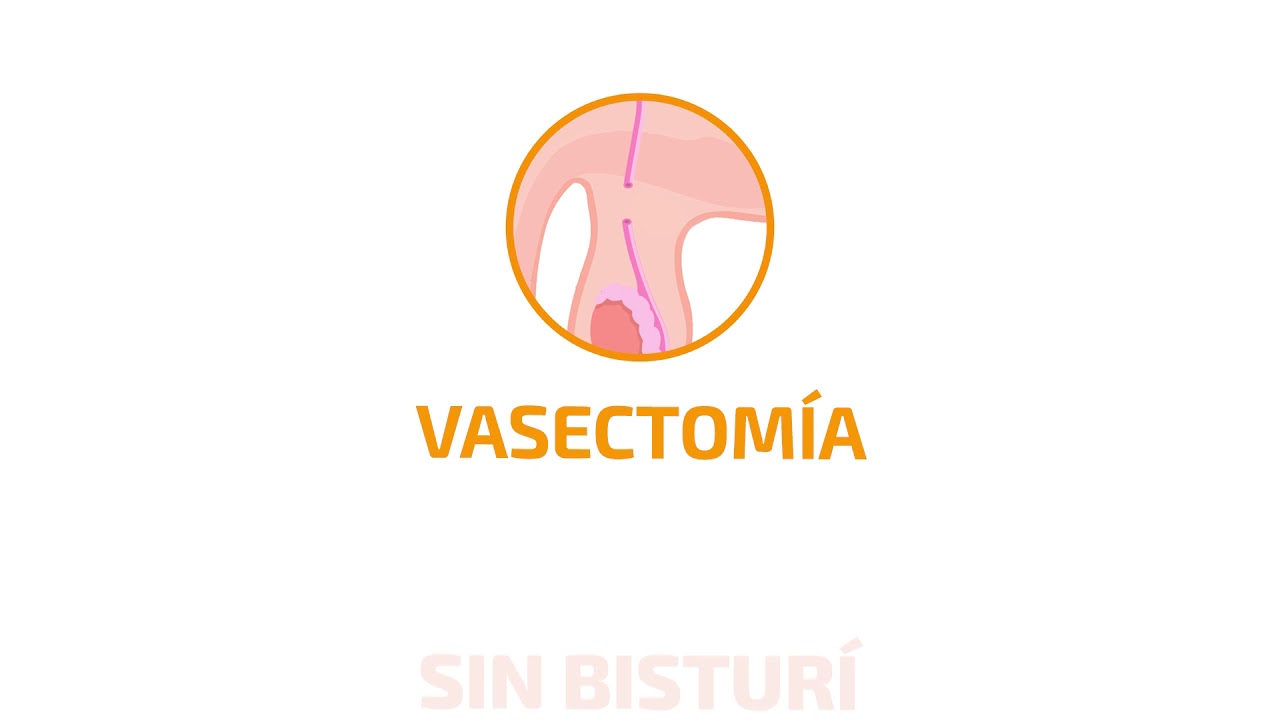 vasectomia sin bisturi precio peru vasectomia sin bisturi precio peru