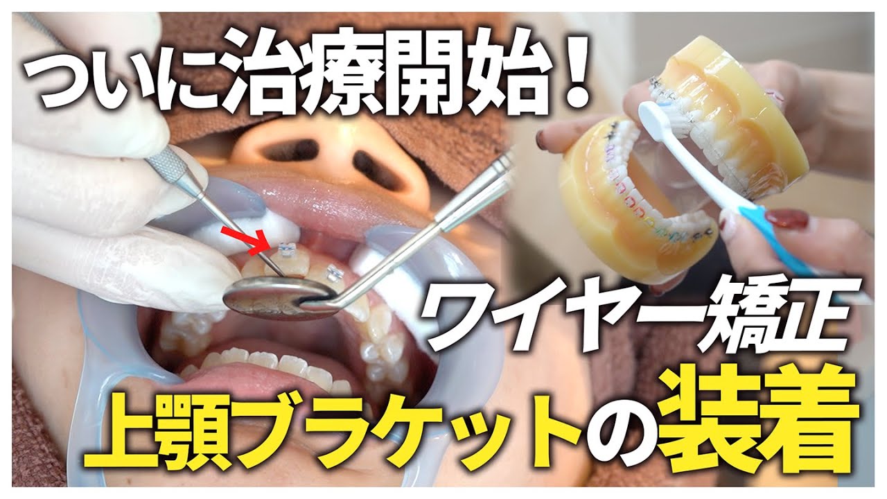 【ワイヤー矯正】上顎のブラケット装着に密着！ 【名古屋茶屋歯科・矯正歯科】