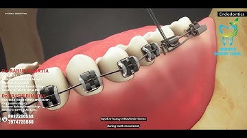 External Root Resorption (Endodontics) : Causes and Treatments by Bhartia Dental Clinic