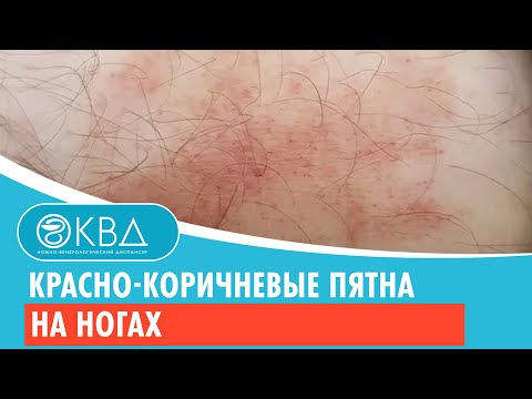 ?? Красно-коричневые пятна на ногах. Клинический случай №416