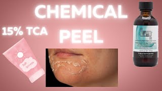 Chemical Peel |15% TCA