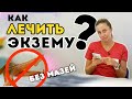 Как вылечить экзему? Просторе решение без кучи мазей (если есть варикоз)