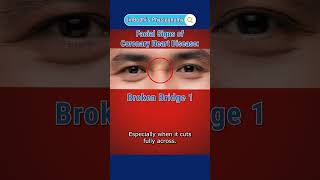 A wrinkle on the nose bridge can be a sign of heart problems? #JinBodhiPhysiognomy #heartdisease Resimi