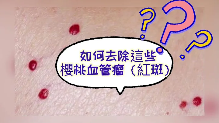 樱桃红血痣|红斑|如何去除？ - 天天要闻