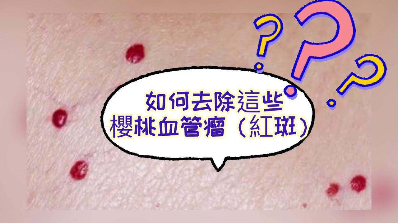櫻桃紅血痣|紅斑|如何去除? - YouTube