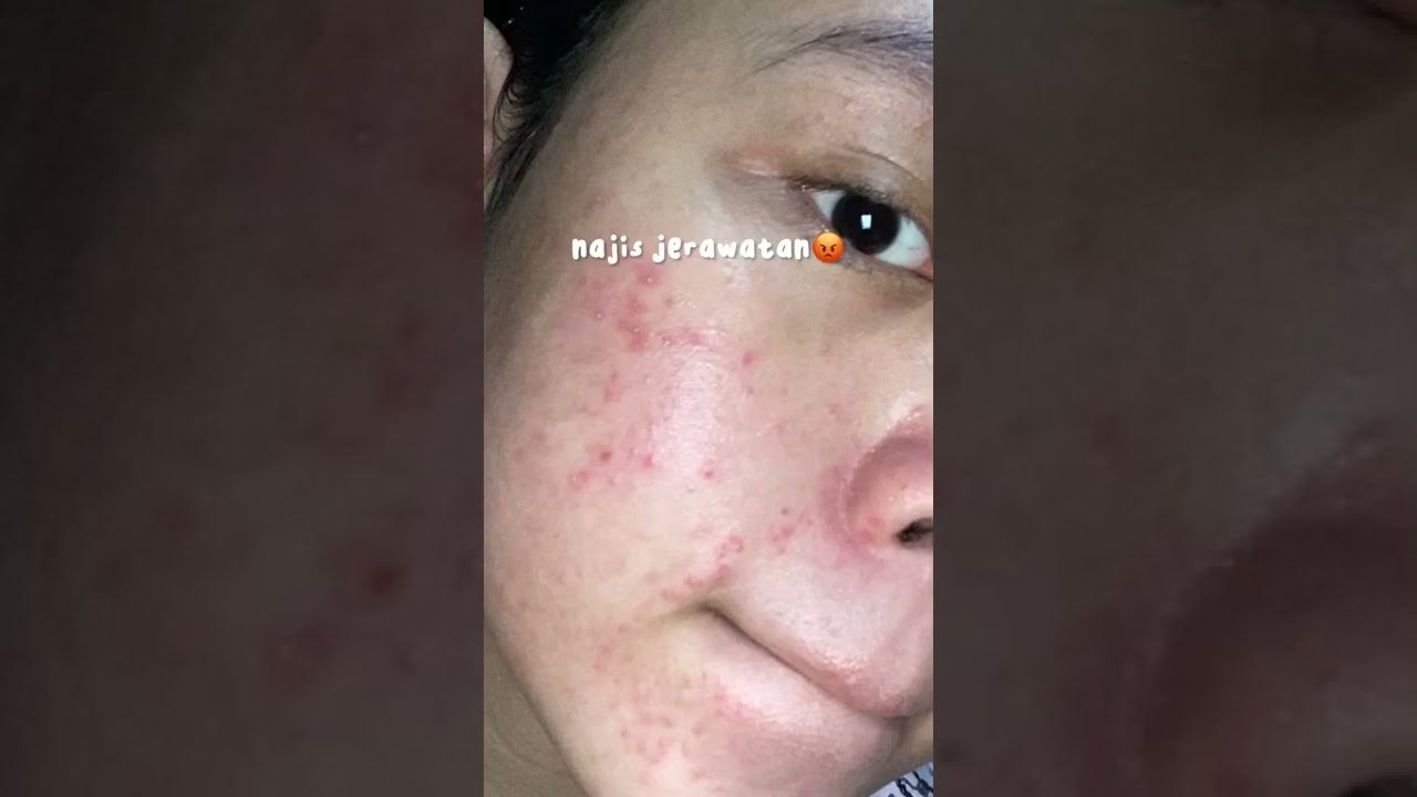 SLEEPING MASK ATASI SEMUA PERMASALAH WAJAH REMAJA CUMA 15 RIBU +LINK SHOPEE TERMURAH 