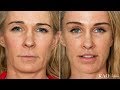 Facelift Before & After - Ponytail Lift™ - Upper Lip Lift - Kao Plastic Surgery - Mommy Makeover