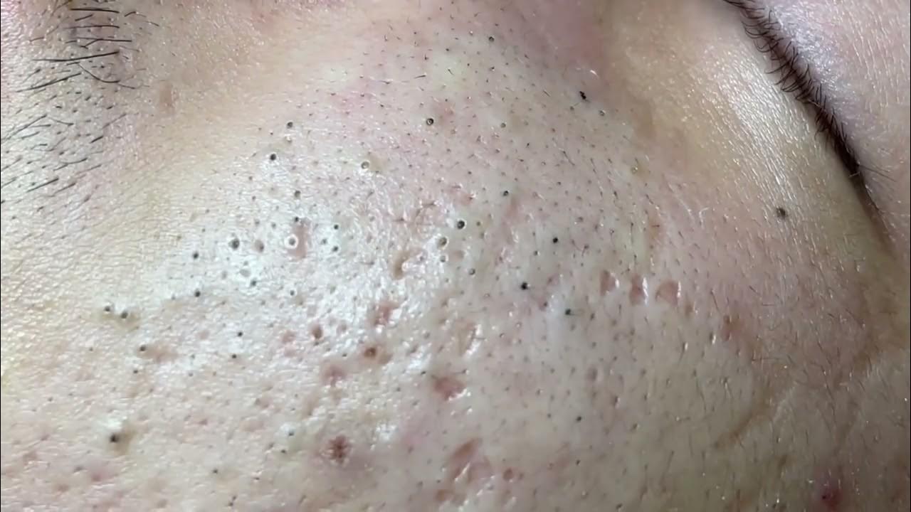 Blackheads Removal with Hari Satisfying YouTube