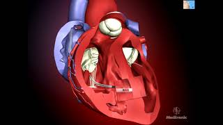 Pacemaker (PPM) Implantation