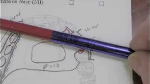 R P D Design - Ken Class II Max Cast #4 Part C