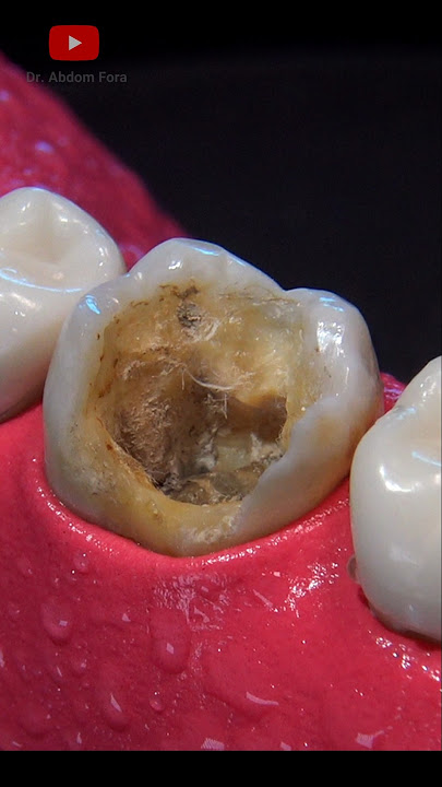 Indirect Dental Restoration: Onlay #shorts