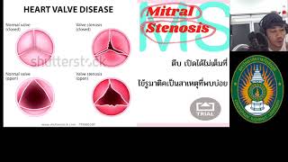 สอนเรื่อง Vulvular Heart Disease