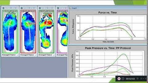 In-shoe F-Scan Pressure Mapping