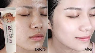 सभी इस क्रीम को लगाना चाहते है ? Miracle Shine & Glow Cream For Hyperpigmentation | Skin Lightening