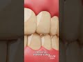 Does vitamin D deficiency cause cavities